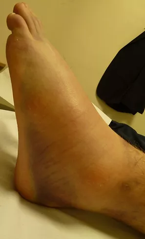 testimonial-sprainedAnkle