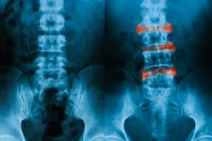 Ankylosing Spondylitis