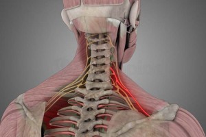 Cervical-Radiculopathy