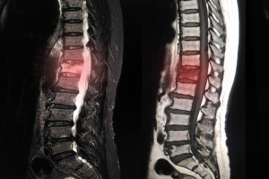 Degenerative Disc Disease