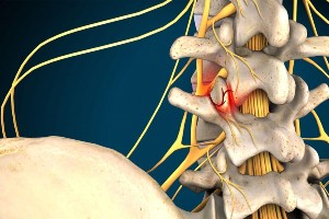 Facet Joint Syndrome