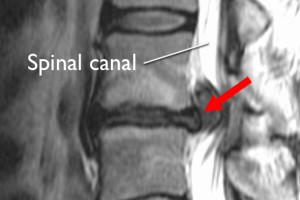 Lumbar Disc Herniation
