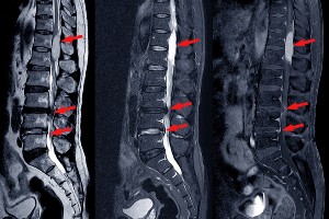 Spinal Stenosis