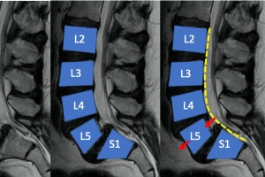 Spondylolisthesis
